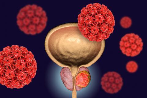 Cáncer de próstata-información y síntomas